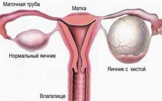Признаки и лечение кистозных образований разного размера