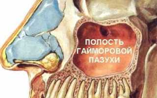 Зубная боль при гайморите: причины, симптомы, лечение, профилактика