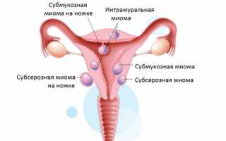 Характеристики многоузловой матки, методы ее лечения