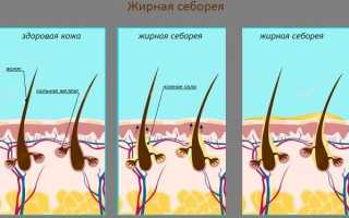 Жирная себорея – жирная кожа, жирные волосы – это болезнь? К какому врачу обращаться? 