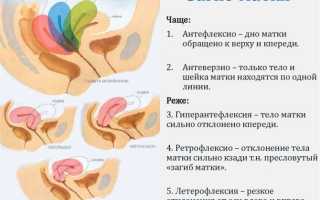Если матка отклонена влево, вправо или кзади, как забеременеть быстро с первого раза, используя позы для зачатия