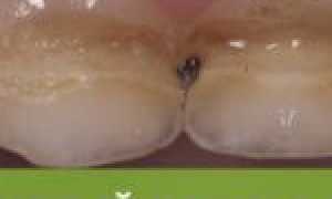 Бутылочный кариес у детей: как проявляется, нужно ли лечить?
