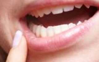 Как лечить стоматит на десне: наиболее эффективные методы