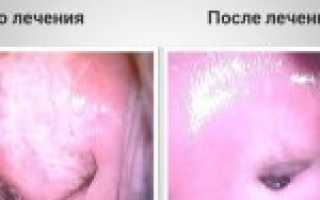 Как проводится электроконизация шейки матки при дисплазии и какой у нее послеоперационный период + отзывы женщин