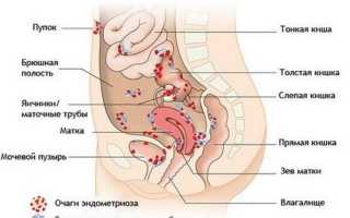 Женская патология — эндометриоз толстого кишечника