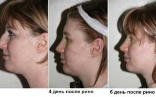 Отеки после пластики носа. Когда спадет отек после ринопластики?